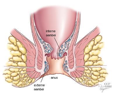 Aambeien (hemorroïden) zijn uitgezakte zwellichamen in de buurt van de anus. De zwellichamen heeft iedereen.