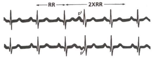 Premature atriale contractie (PAC)