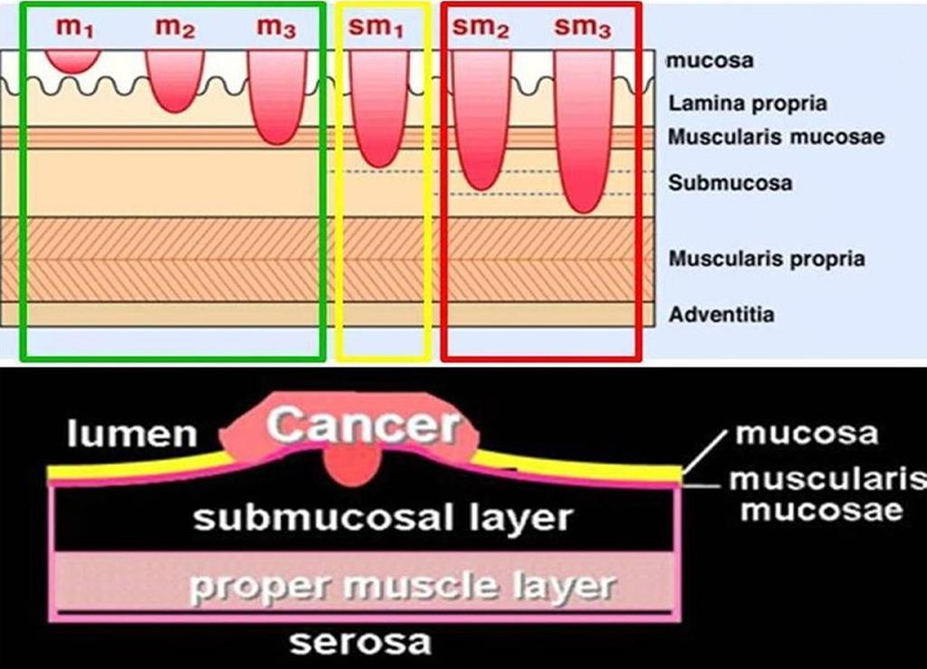 Fig.1: Schematische voorstelling van de verschillende lagen van de darmwand met mucosa, muscularis mucosae, submucosa, muscularis propria en adventitia/serosa.