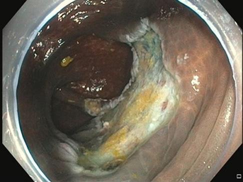 vroegtijdige carcinomen. Kleine adenomen kunnen meteen tijdens een colonoscopie verwijderd worden met een diathermische lus (klassieke poliepectomie; Figuur 8).