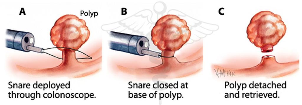 Fig.8: Klassieke poliepectomie (met