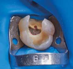 EEN ANDERE KIJK OP RECHTSTREEKSE CAD/CAM-RESTAURATIES KIES VOOR HYBRIDE KERAMIEK (GC CERASMART) In de onderstaande situatie ontdekt u hoe Cerasmart wordt gebruikt voor een onlay na endodontische