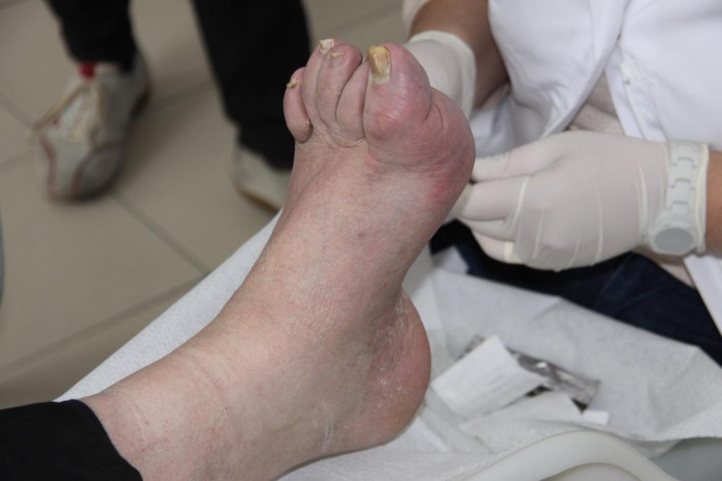 15-04-18 Typisch neuropathische voet Een diabetische voet Welke