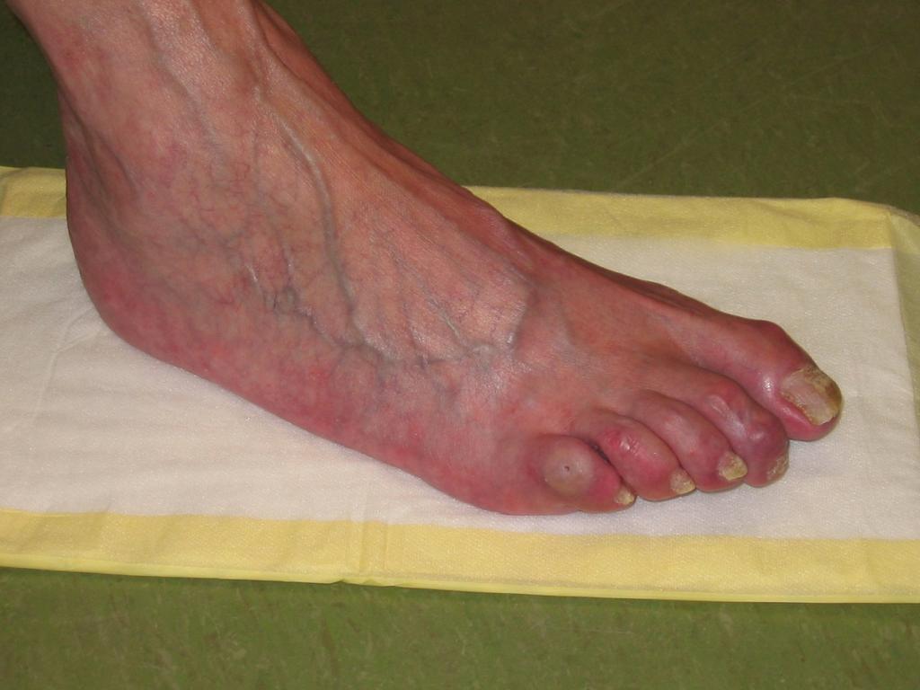 19 20 Dé Diabetische voet Definitie in beeld Overmatige