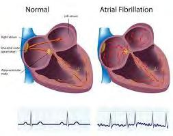 Elektrocardiogram (ECG) De diagnose van vkf wordt bevestigd via een ECG. Het is een eenvoudig en gemakkelijk onderzoek om de elektrische activiteit van het hart vast te leggen.