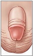 FIMOSIS OF VOORHUIDVERNAUWING Bij fimosis is de voorhuid van de penis zodanig vernauwd dat deze niet of nauwelijks teruggetrokken kan worden over de eikel.