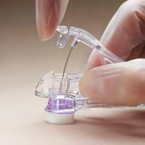 40%* Met de GRIPPER Micro kunnen dunnere naalden worden gebruikt, om zo het ongemak voor de patiënt te minimaliseren De stompe canule maakt 360 flushing en flow in
