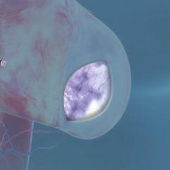 Een interventioneel cardioloog en een cardiothoracaal chirurg werken samen om de linkerkamer opnieuw te construeren met behulp van het Revivent TC via katheter geplaatst ventrikelverbeteringssysteem.