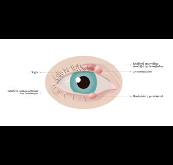 Verstopte Meibomklieren vormen waarschijnlijk de belangrijkste en meest voorkomende oorzaak van klachten van droge ogen (zie ook de NOG-folder Droge ogen).