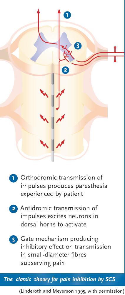 Gate control theorie 1. Orthodrome transmissie van impulsen produceert paresthesiën 2.