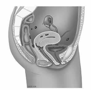 Inleiding Endometriose is de situatie waarbij baarmoederslijmvlies buiten de holte van de baarmoeder voorkomt.