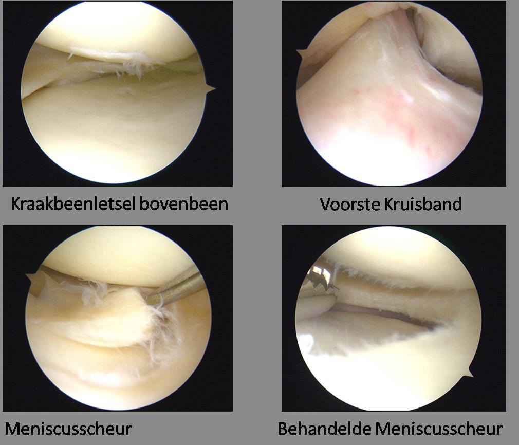 Waarom een kijkoperatie Tijdens de kijkoperatie heeft de chirurg direct zicht op de gewrichtsvlakken (het kraakbeen) en de weke delen zoals de meniscus, het gewrichtsvlies en de kruisbanden.