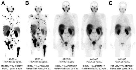 Lutetium-177 PSMA therapie Scan 1 e 2 e 3 e Lutetium-177 PSMA therapie Nog niet bewezen Geen grote studies over effect en bijwerkingen In Duitsland veel