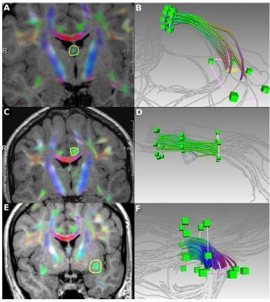 Amygdala en BPS Verhoogde activatie amygdala tijdens inductie van emoties Verminderde connectiviteit met prefrontale