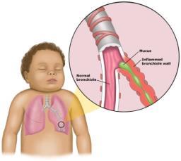 Wat verstaat men onder bronchiolitis?