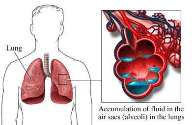 High Altitude Pulmonary Oedema (HAPE) boven 3000m Symptomen: Dyspnoe Verminderde inspannings
