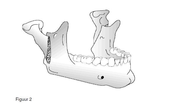 De orthodontist zet de tanden en kiezen zodanig op een rij, dat ze na de operatie goed op elkaar passen.