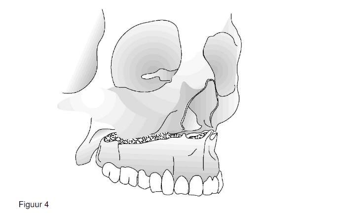 Verplaatsingen van de bovenkaak Bij een groeistoornis in de bovenkaak moet deze vaak worden verplaatst (figuur 4). Ook dat gebeurt via een opening in het slijmvlies van de mond, achter de bovenlip.