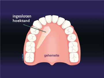 WAT IS EEN INGESLOTEN HOEKTAND? Hoektanden zijn soms hun doorbraakrichting kwijt en blijven verborgen in het bot liggen. Meestal gaat het om de hoektanden in de bovenkaak.