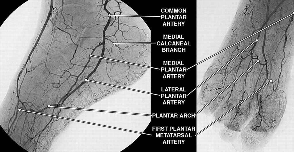 1. Anastomose tussen de A. Tibialis posterior en de A. Peronealis via respectievelijk de mediale calcaneale tak en de laterale calcaneale tak (fig. 12).