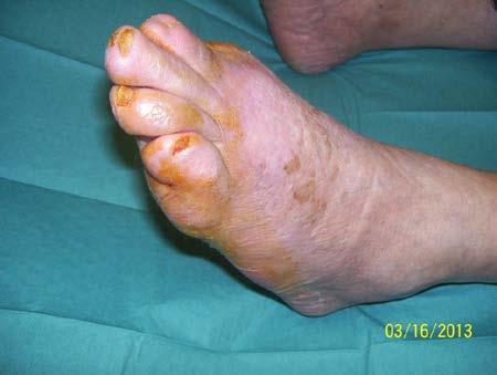 A. Tibialis posterior Figuur 27: