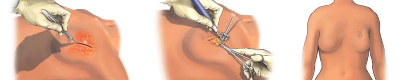 Borstsparende operatie Bij een borstsparende operatie (lumpectomie) wordt een snede gemaakt in de borst. Vervolgens verwijdert de chirurg de tumor met een randje omringend gezond weefsel.