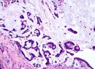 Tumortype Adenocarcinoma
