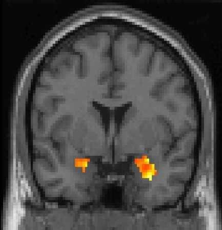 Klinische observaties Experimentele behandelingen Verfijnen raamwerk Het depressieve brein (voor een overzicht, zie De Raedt, 2015) Asymmetrische prefrontale activatie : Causale hypothese