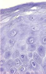 Ichthyosis vulgaris and atopic dermatitis