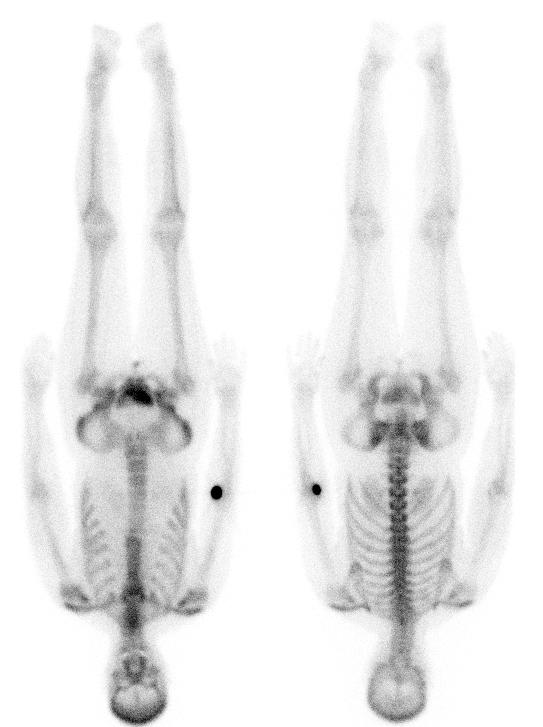 INTRODUCTIE EN UITLEG VOOR LEKEN Figuur 2. Total body botscans. Linker plaatje: normaal beeld, met links aanzicht van voren, rechts van achteren. De activiteit in het skelet is gelijkmatig.