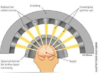 Vormen van stereotaxie Gamma knife Cobalt-60 bronnen Invasief frame