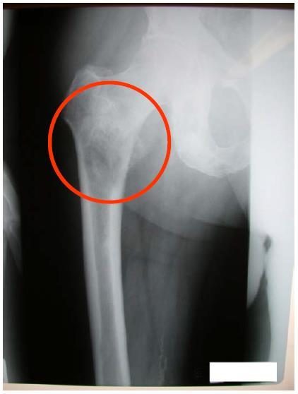 Casus 72 jarige matig vitale man met gemetastaseerd rectumcarcinoom met ossale metastasen - Pijn heup rechts - X femur: