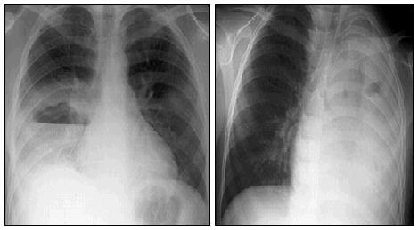 Pneumonie met abces en