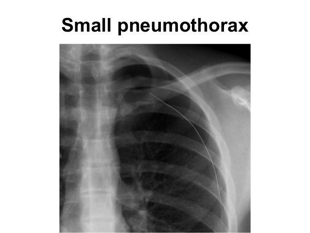 Behandeling pneumothorax Kleine randpneumothorax (minder dan 2-3
