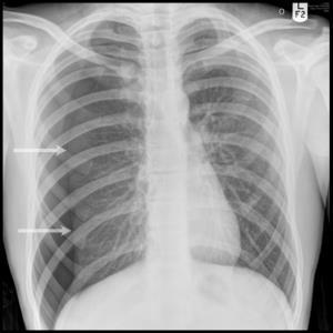 Behandeling pneumothorax Bij grotere pneumothorax (> 2-3 cm) drainage en O2 suppletie