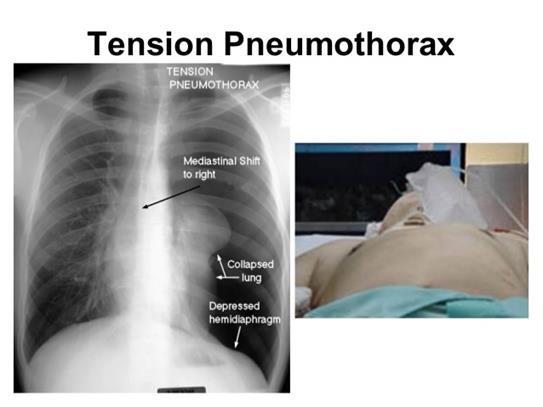 Spanningspneumothorax Mediastinale shift op X-thorax kan,