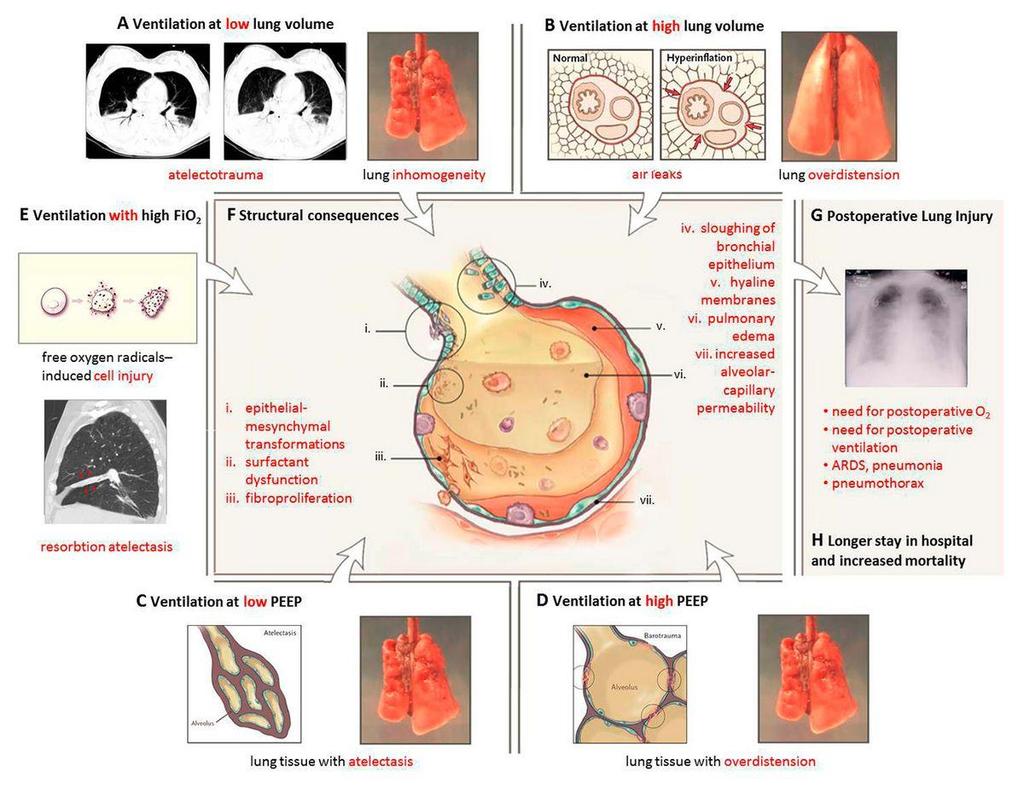 Afbeelding 1: Postoperative pulmonary complications caused by forces generated by ventilation at low and high lung volumes, low and high PEEP and high FiO2 (Adapted from: Slutsky AS, Ranieri VM.