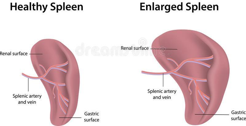 Indicaties voor bloedtransfusies: acute correctie anemie 2. Acute milt sequestratie: daling >1.