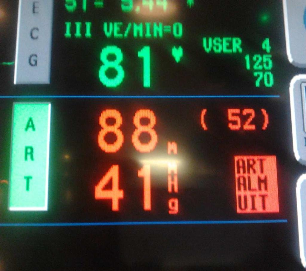 Je hebt een drukke late dienst en jouw patient heeft een arterielijn in de art radialis rechts.