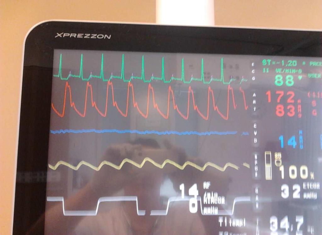 Mw postoperatief na bio AVR en 2x CABG 1 uur post OK Nog erg slaperig van de narcose ASV beademing, nog weinig spontane