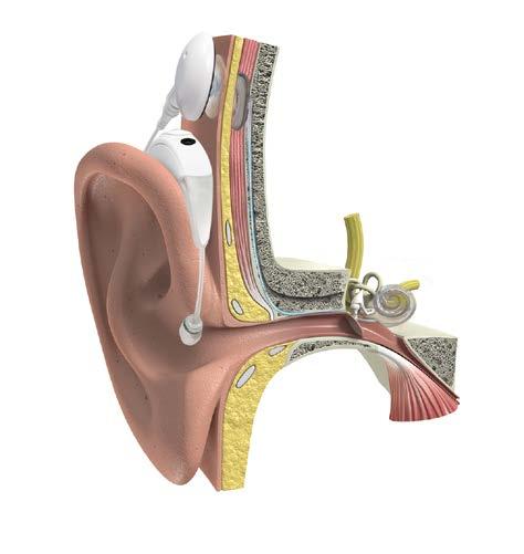 2 Dit toestel slaat het beschadigde gedeelte van de cochlea over en herstelt het gehoor door geluid rechtstreeks naar de zenuw te verzenden.