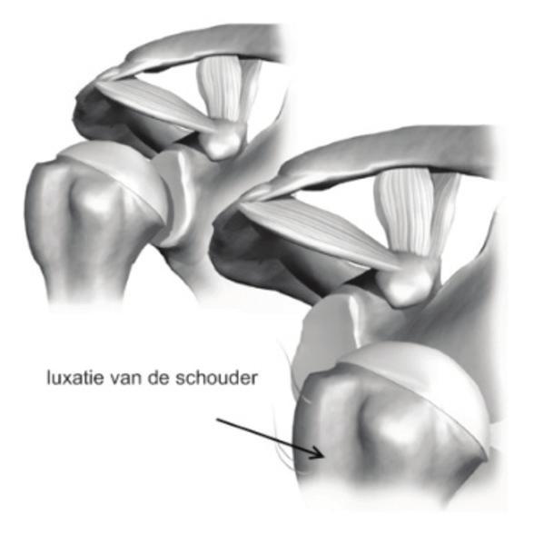Scopische ( Kijkoperatie ) Labrum Fixatie Schouder instabiliteit Het schoudergewricht is zeer beweeglijk en van zichzelf een minder stabiel gewricht dan bv. het heupgewricht.