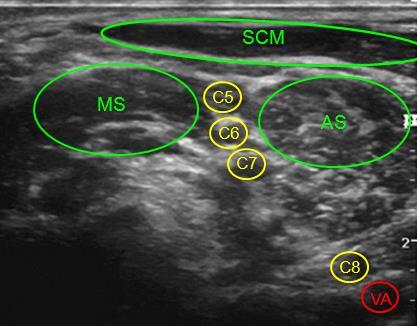 scalenus anterior Figuur 33: Zwarte bollen