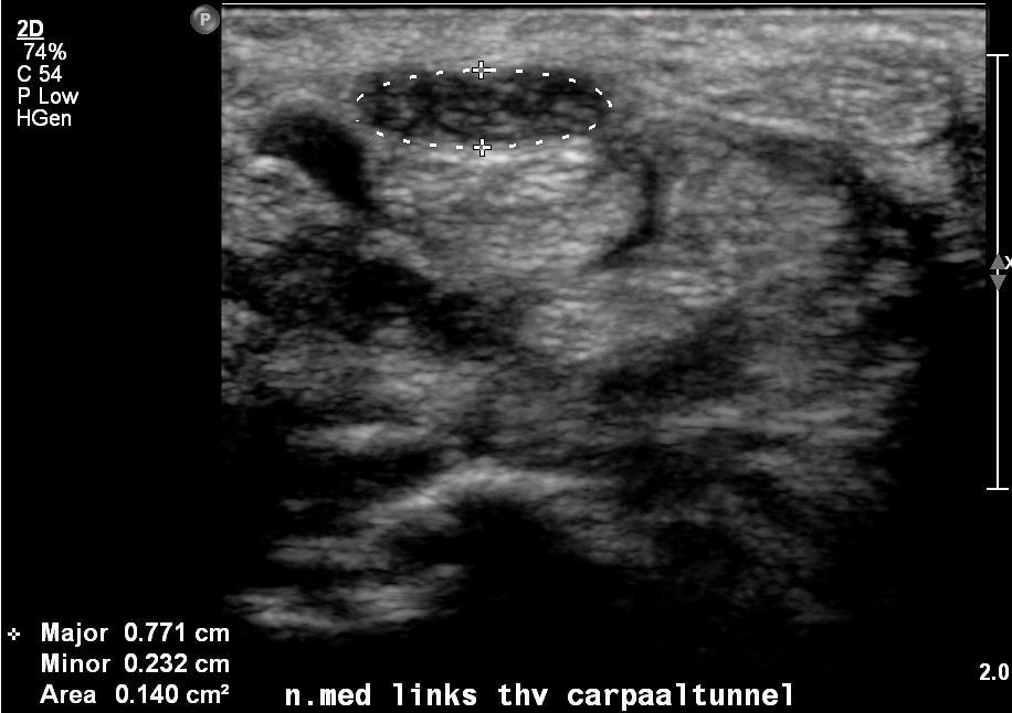 Figuur 4: verdikte n. medianus thv de carpaal tunnel Figuur 5: n.