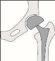 De operatie Om bij het heupgewricht te kunnen komen, maakt de chirurg een snee aan de zijkant van uw bovenbeen. De operatie kan op verschillende manieren plaats vinden afhankelijk van de soort breuk.