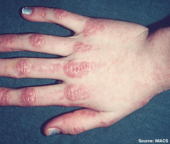 Bij Dermatomyositis zie je soms Gottronse papels bij de vingers. Bij dermatomyositis is er bij 30% een onderliggende maligniteit.