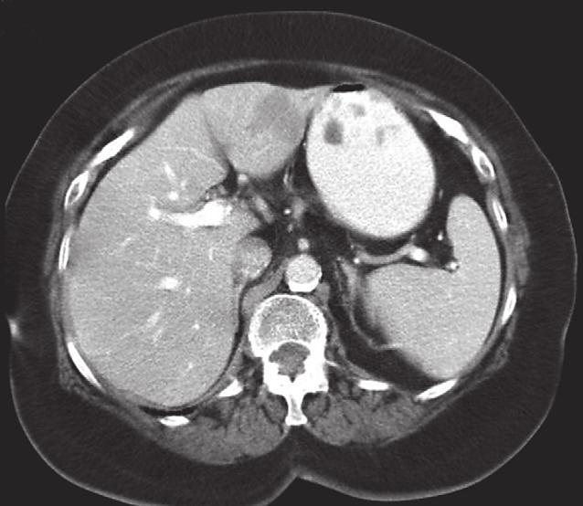 a b ablatiezone maag VII VIII II I IV III metastase lever aorta milt VI V ductus hepaticus communis A. hepatica propria V. cava c ductus cysticus galblaas V. cava inferior A. hepatica communis V.