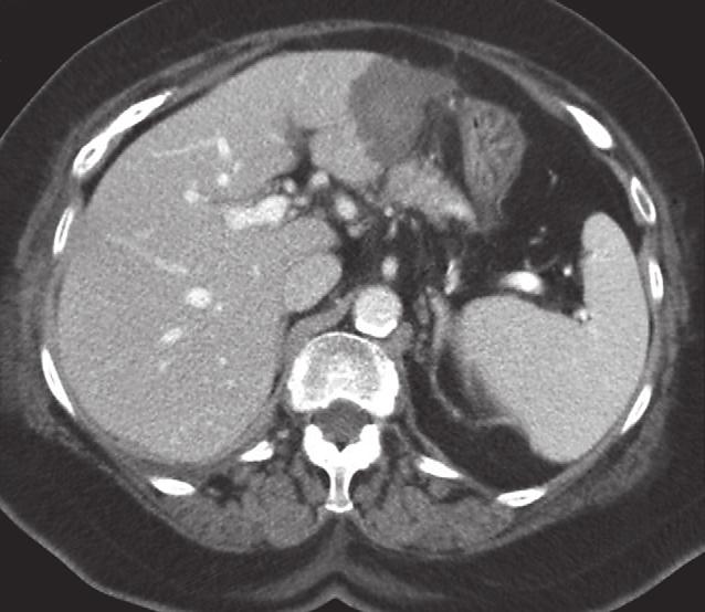 van 27 mm; (b) postoperatief na een volledig laparoscopische behandeling met RFA (tekeningen: mw.m.kunen); (c) indeling van de leversegmenten volgens Couinaud (figuur afkomstig uit een eerder artikel).