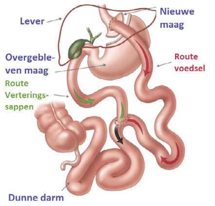 Gastric Bypass De Gastric Bypass houdt in dat de maag aanzienlijk wordt verkleind. Vervolgens wordt de dunne darm vastgemaakt aan de nieuwe maag (route voedsel).