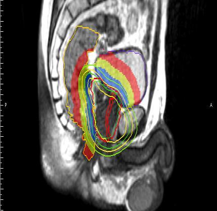 MRIdian reoptimalisatie